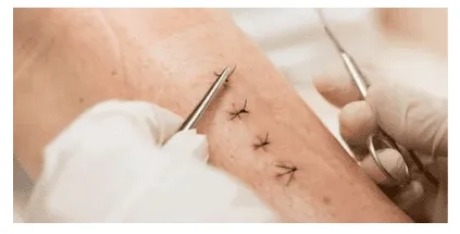 Thủ thuật cắt chỉ vết thương khâu chuẩn y tế