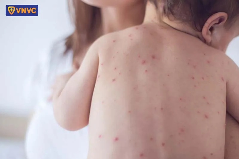 Trẻ em cần được bảo vệ bằng lưới ngăn côn trùng và tiêm chủng đầy đủ tại các đơn vị uy tín