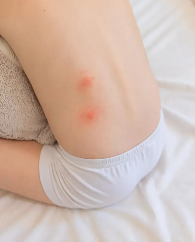 bé bị nhện cắn sưng to