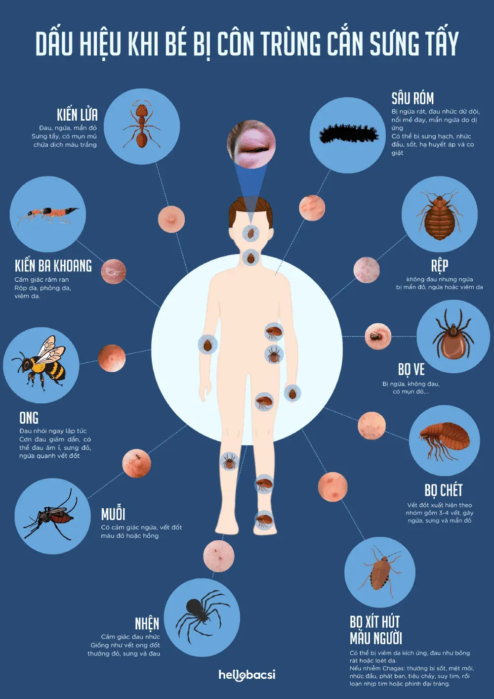 bé bị côn trùng cắn sưng tấy