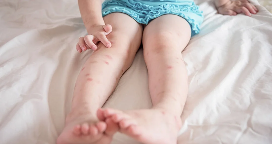 bị côn trùng cắn đi khám ở đâu - hình minh họa 2