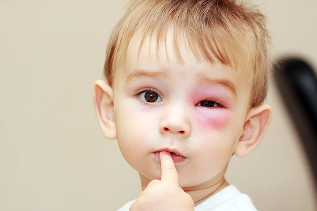 phân loại mức độ sưng mắt do côn trùng cắn cách chữa sưng mắt khi bị côn trùng cắn theo mức độ sưng phù quanh mắt