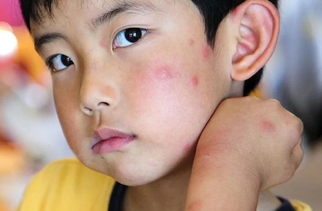 dấu hiệu sưng mắt do dị ứng và nhiễm trùng cách chữa sưng mắt khi bị côn trùng cắn và dấu hiệu nhiễm trùng quanh mắt