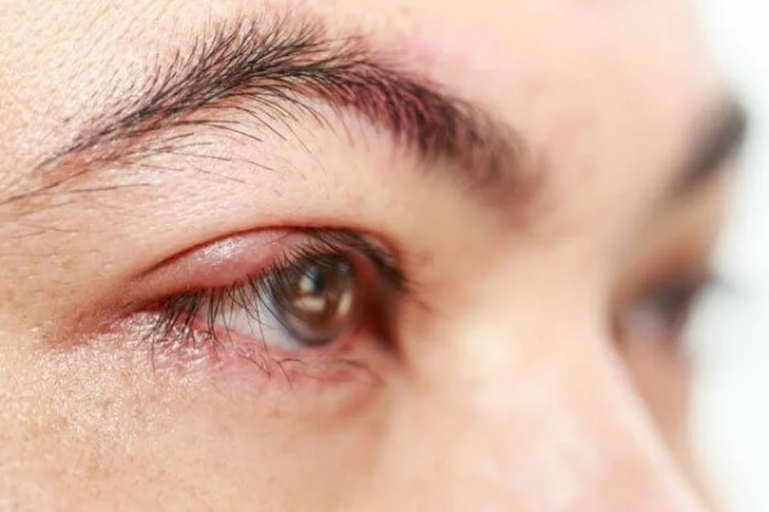 cách giảm sưng mắt khi bị côn trùng cắn - hình minh họa 2 cách giảm sưng mắt khi bị côn trùng cắn - hình minh họa 2
