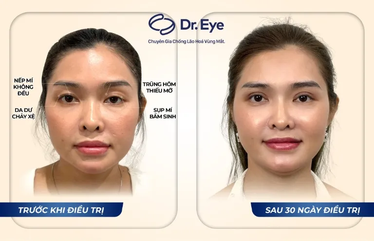 Kết quả thẩm mỹ tuyệt vời nhờ sự kết hợp giữa kỹ thuật bác sĩ và chế độ ăn uống khoa học