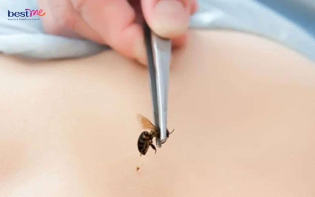 côn trùng cắn nổi mụn nước và các bước chăm sóc tại nhà