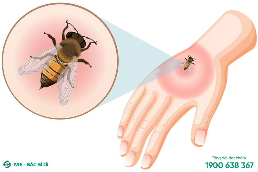 Ong bắp cày đốt gây sưng đau