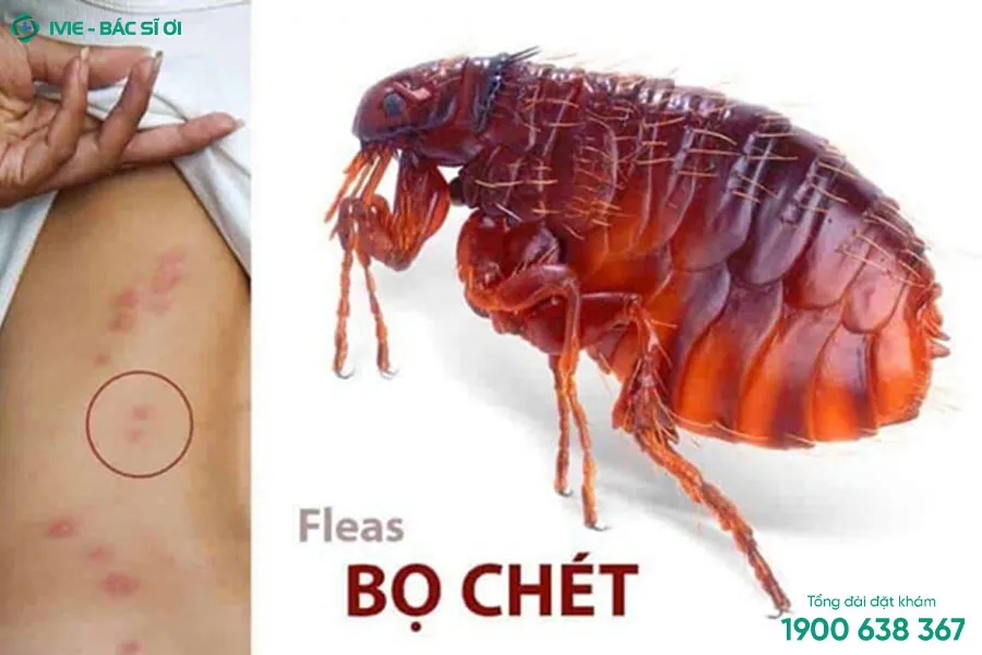 Cách xử lý vết sưng đỏ ngứa do bọ chét