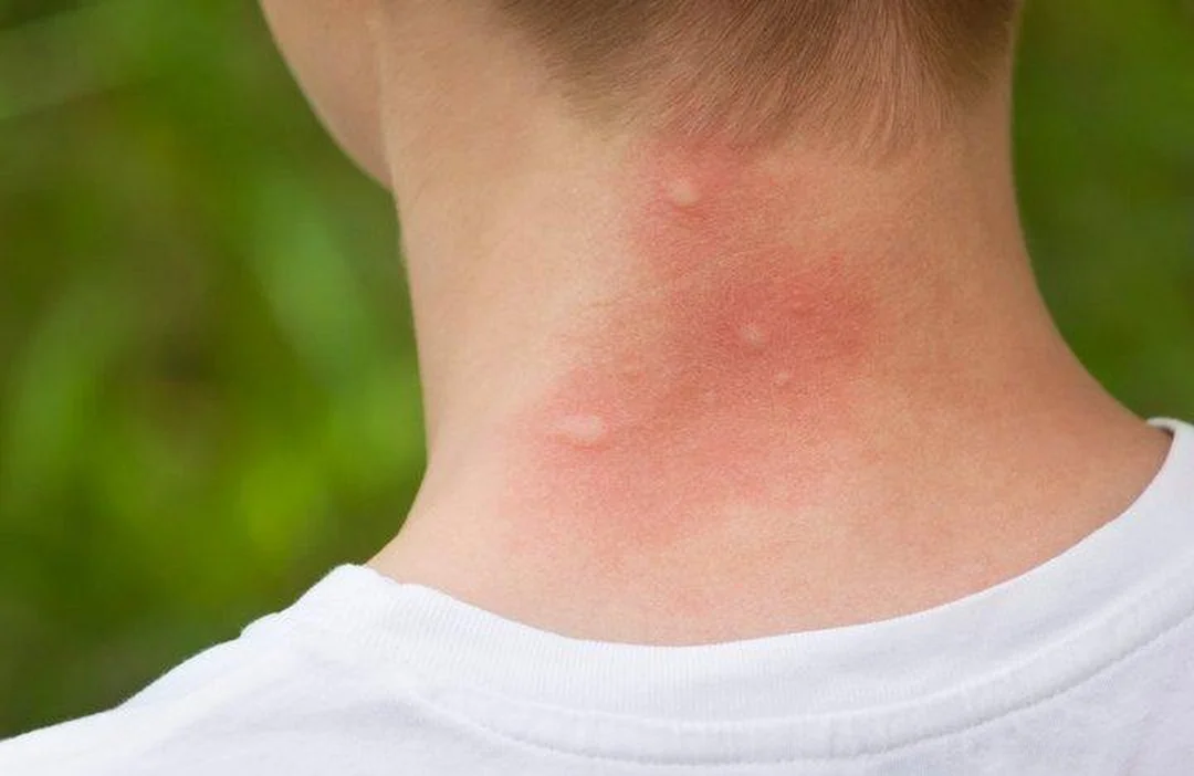 Dấu hiệu nguy hiểm khi bị côn trùng cắn cần đi khám