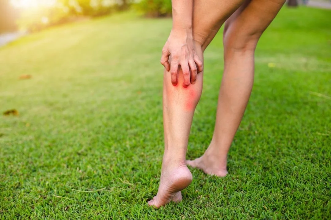 dấu hiệu nguy hiểm sau côn trùng cắn sưng cứng