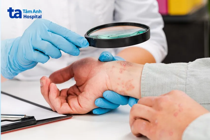 phản ứng viêm da do vết đốt của các loại côn trùng thường gặp trong vườn