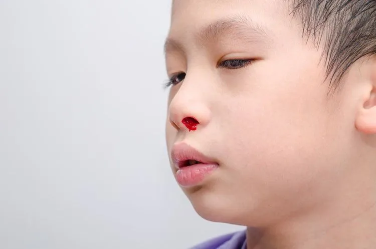 Cần lập kế hoạch chăm sóc bệnh nhân sốt xuất huyết khi có chảy máu cam