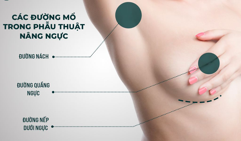 Nâng Ngực: Cẩm Nang Chi Tiết Về Phương Pháp Làm Đẹp Vòng Một