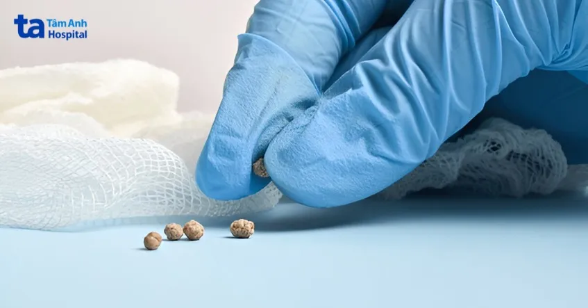 sỏi niệu quản có kích thước nhỏ có thể được điều trị