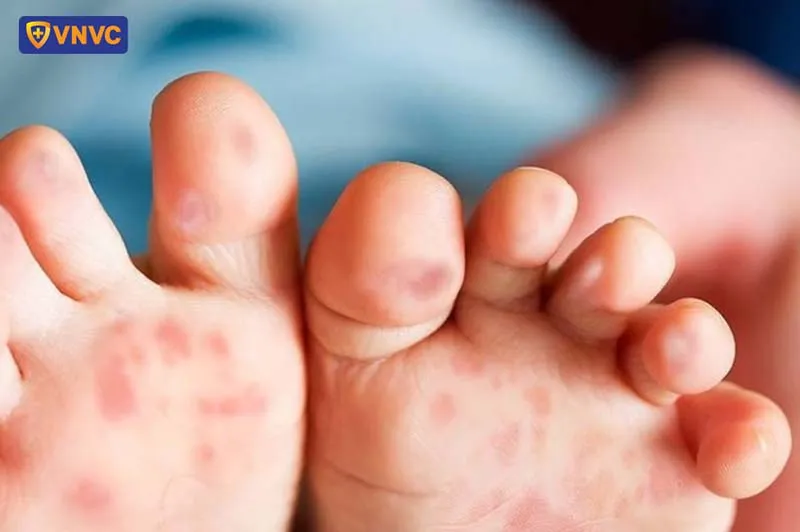 Kiểm tra tổn thương da do côn trùng đốt để có biện pháp can thiệp y tế kịp thời