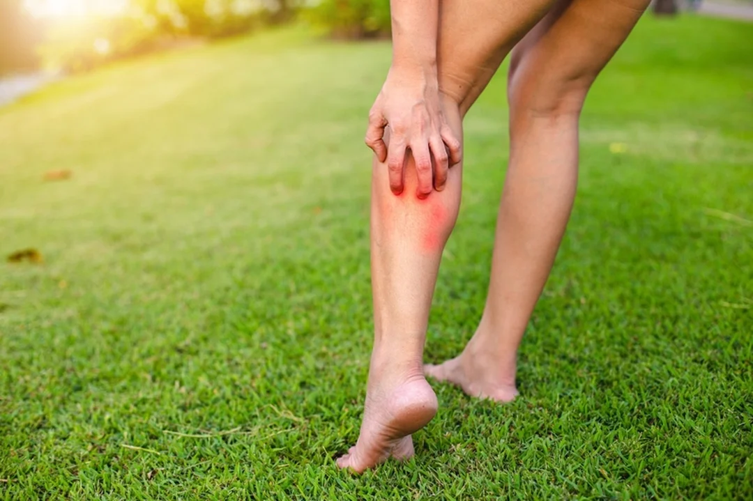 vết côn trùng cắn lâu lành - hình minh họa 4 vết côn trùng cắn lâu lành - hình minh họa 4