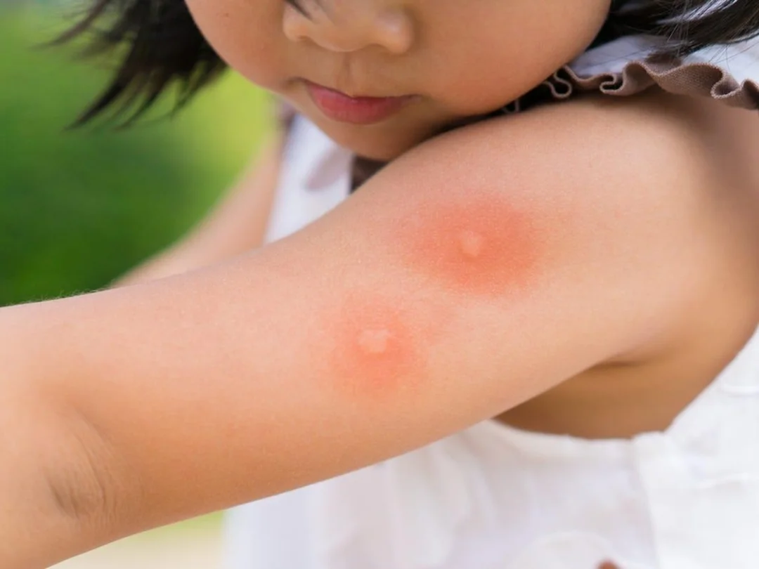 vết côn trùng cắn sưng đỏ ngứa và sưng cứng