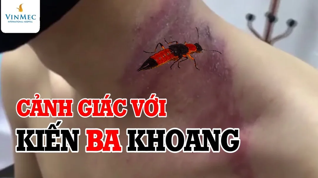 Video bác sĩ hướng dẫn xử trí kiến ba khoang và viêm da tiếp xúc côn trùng