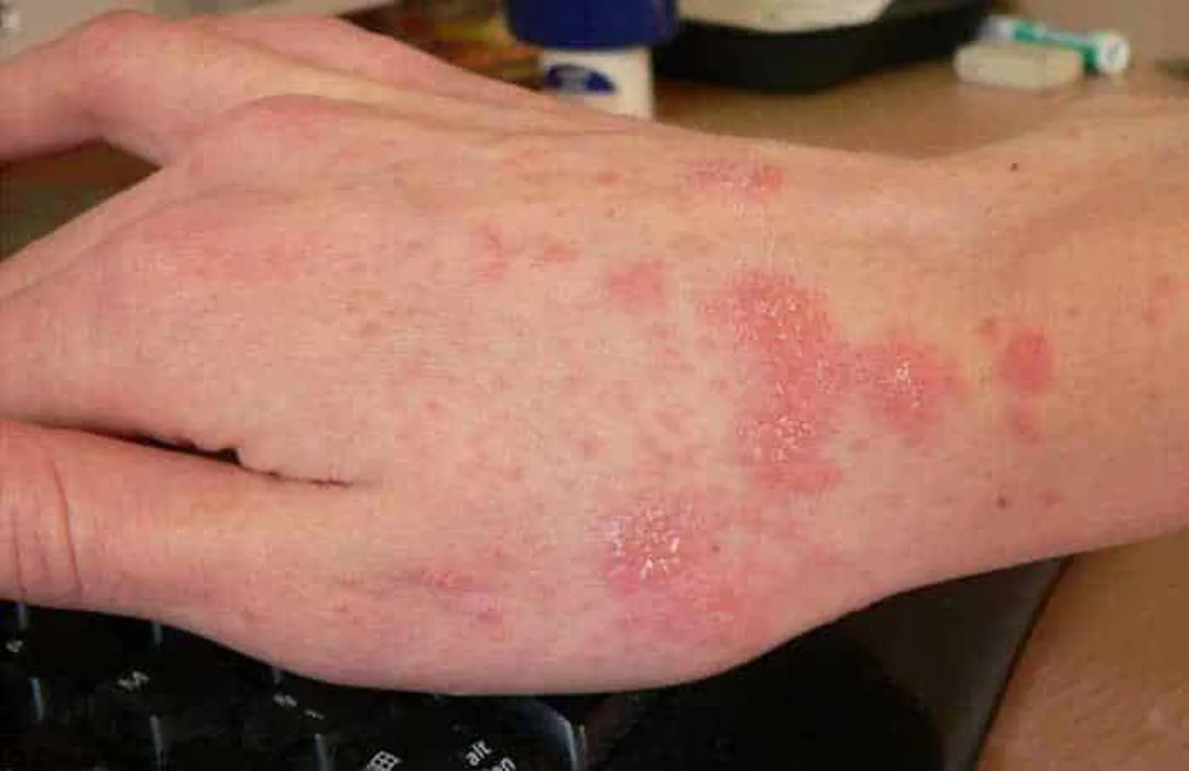 Viêm da tiếp xúc côn trùng với dát đỏ và mụn nước ở da